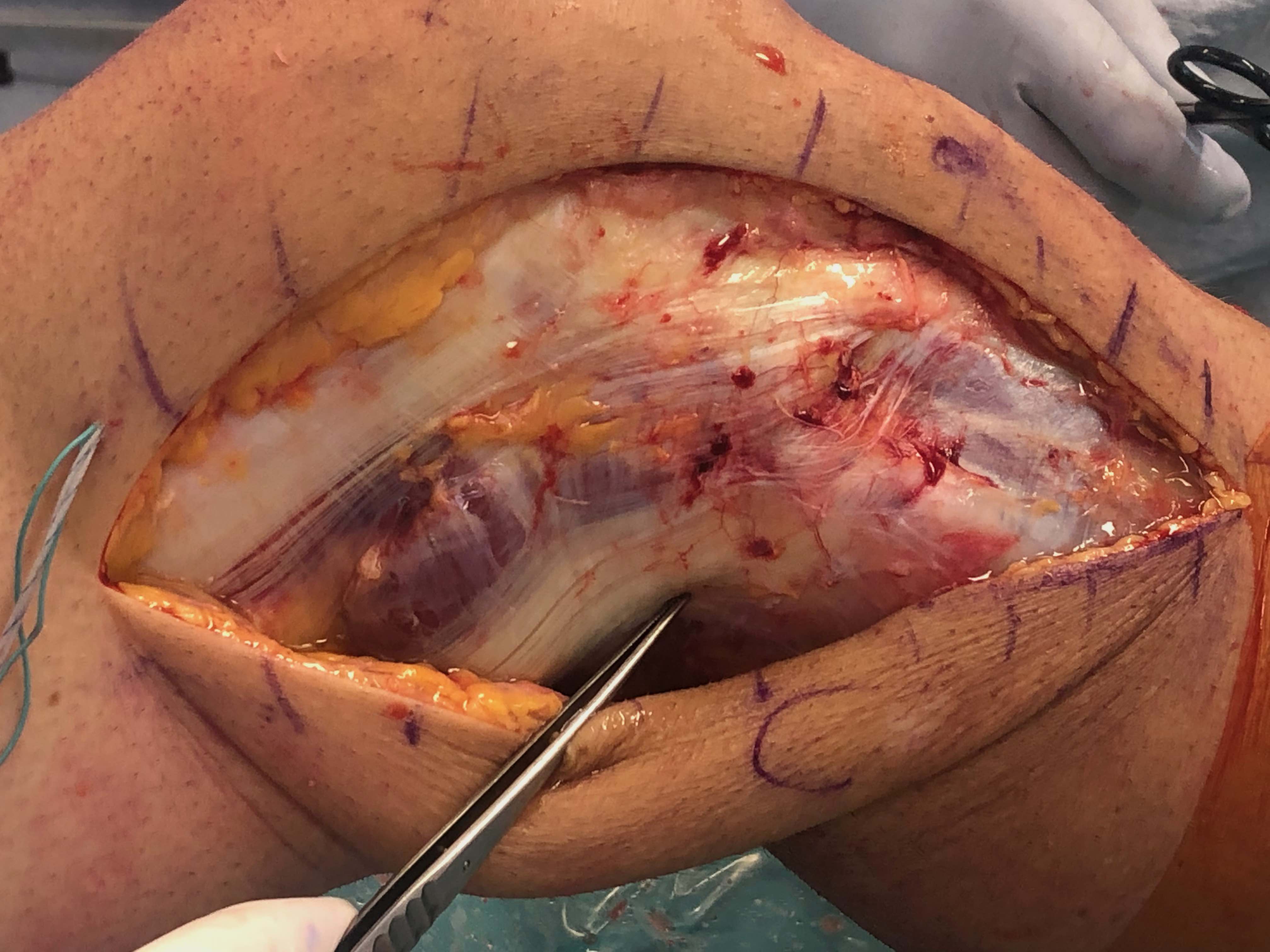 Posterior window CPN